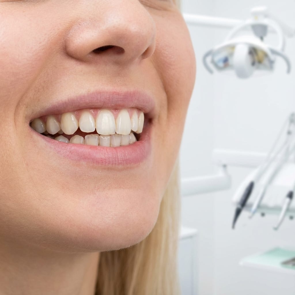 Before Overbite Correction