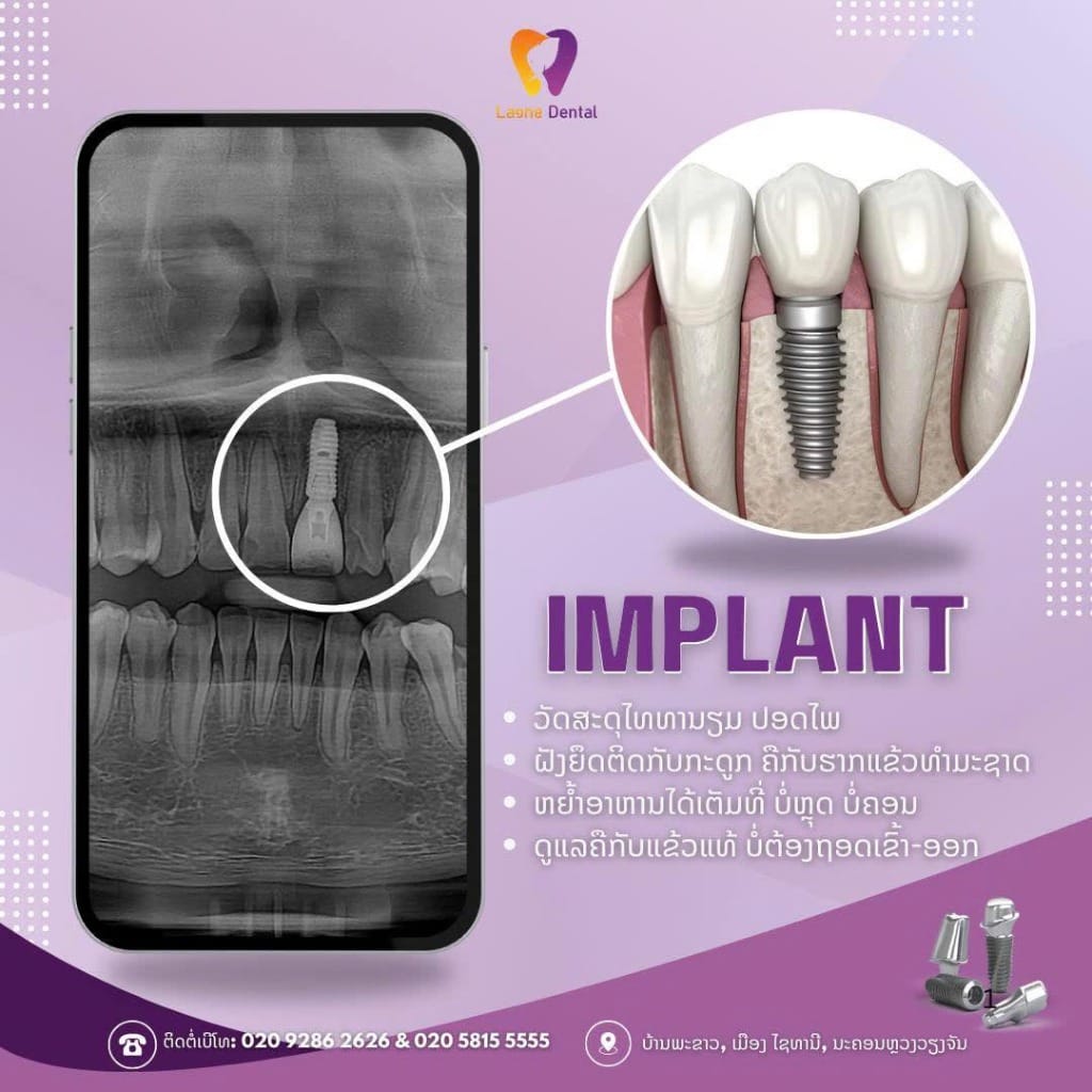 Dental Implants - Replace missing teeth with titanium implants. Strong and durable like natural teeth.